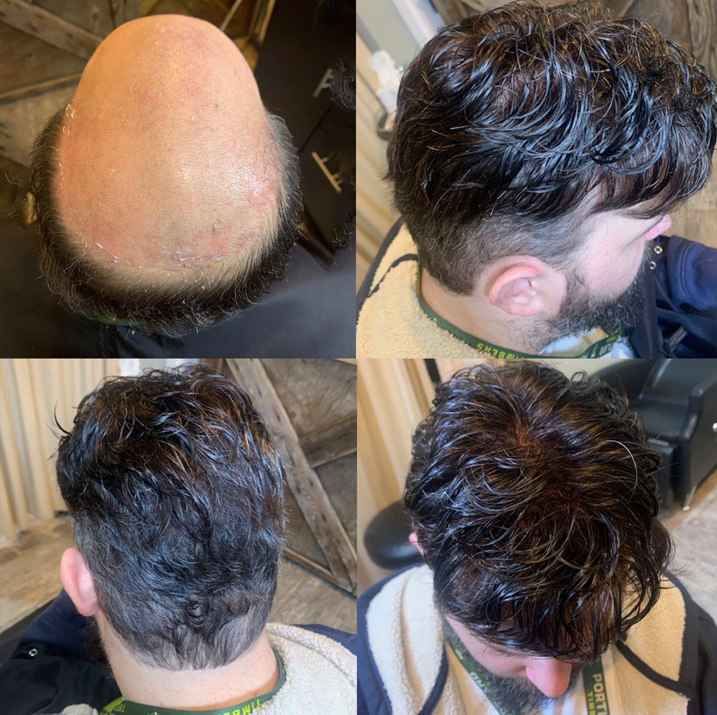 Male Hair Replacement